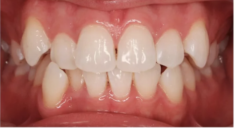 Ortodoncia Completa - Antes